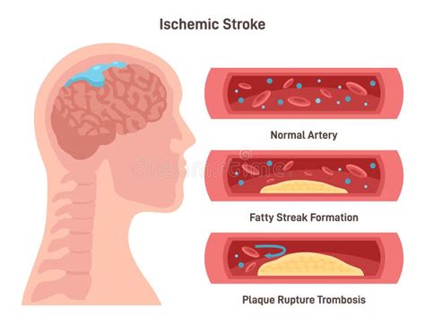 Ischemic Brain Stroke Damaged Human Brain Blood Supply Interrupted