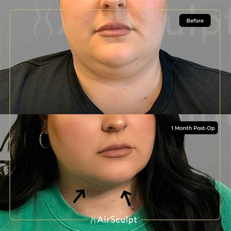 See What Double Chin Removal With Airsculpt Achieved In Just One Month