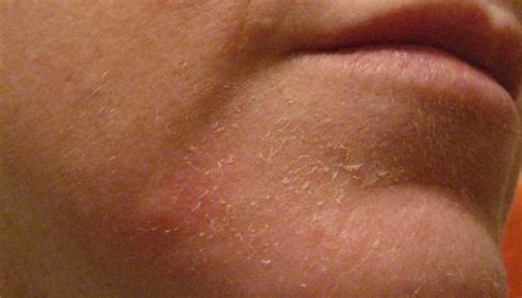 Causes And How To Get Rid Of Dry Flaky Skin On Face Skincarederm