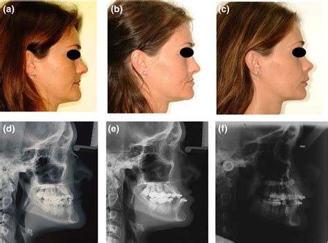 Versatile Facial Osteotomies Lim 2018 Australian Dental Journal