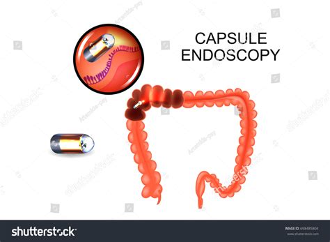 Vector Illustration Capsule Endoscopy Colon Stock Vector Royalty Free