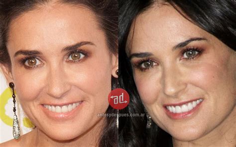 Celebrities Who Use Botox Before And After Photos Biography And