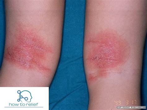 Eczema Symptom Causes Medication And Ointment How To Relief