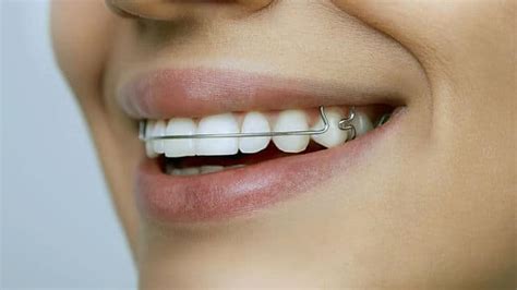 Gum Swelling While Wearing Braces Orthodontic Excellence