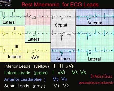 12 Ekg Leads Nursing Mnemonics Nurse Nurse Practitioner School