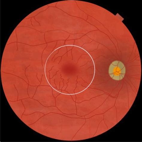 Macula On Rhegmatogenous Retinal Detachment Eyewiki