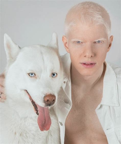 Albinism Nude