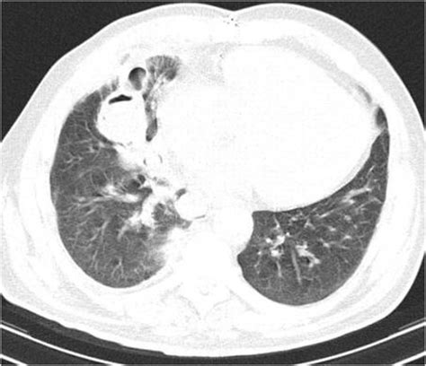 Ct Guided Percutaneous Drainage Of Lung Abscesses Review Of 80 Cases