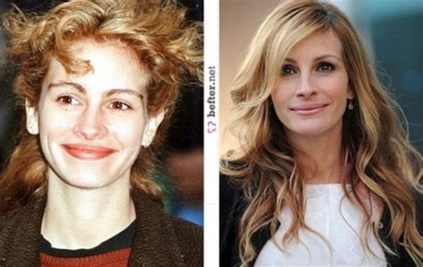 Julia Roberts Plastic Surgery Before And After Botox Injection And Nose