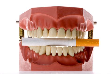 Cáncer Bucal Como Prevenir Directorio Odontológico