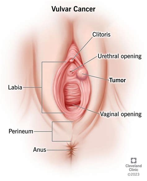 Normal Bumps On Labia