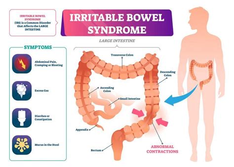 Do I Have Irritable Bowel Syndrome Gastroenterologists Located In Belmont Office Belmont