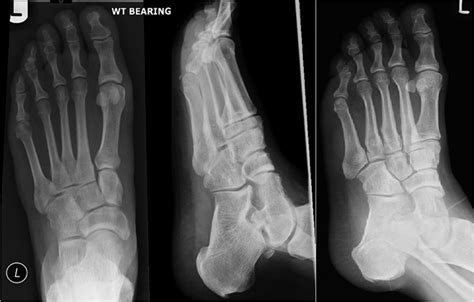 Primary Septic Arthritis Of Talonavicular Joint Bmj Case Reports