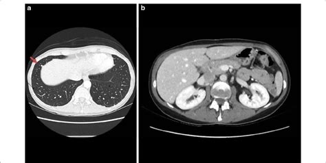 Ct Showing Radiological Response Axial Ct Of The Thorax And Abdomen