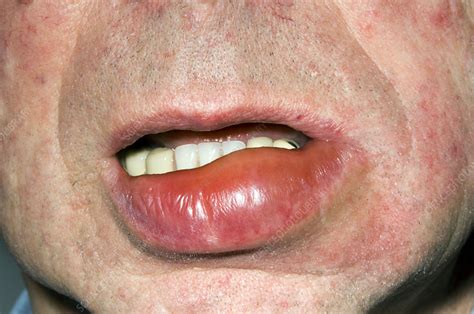 Swollen Lip Stock Image M3200446 Science Photo Library