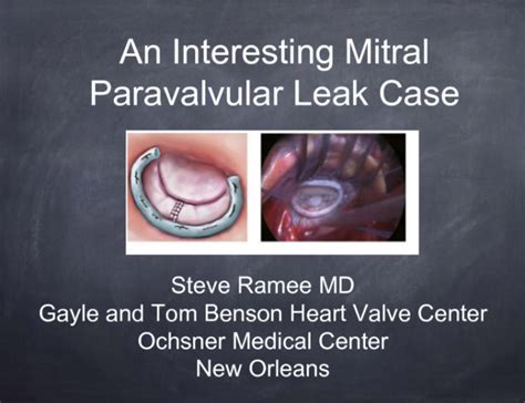 Case 4 A Complex Mitral Paravalvular Leak