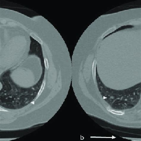 A B 73 Year Old Female Patient With Covid 19 Infection Thorax Ct In