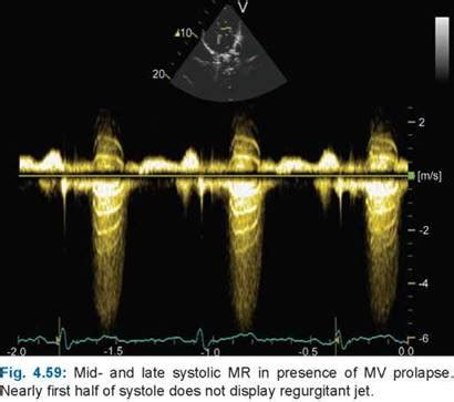 Mitral Regurgitation A Practical Approach To Clinical