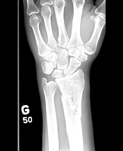 Fracture Left Wrist Iii Christopher Stewart Flickr