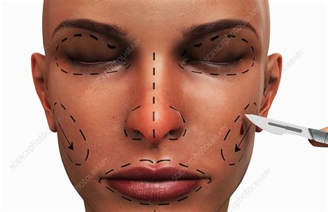 Plastic Surgery Stock Image C0080340 Science Photo Library