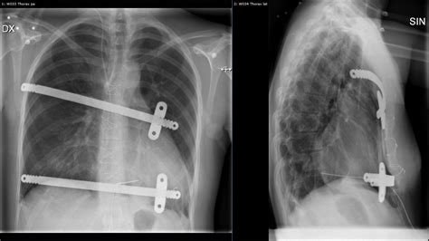 Combining Correction Of Pectus Excavatum And Open Heart Surgery In A