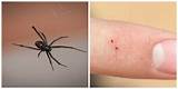 All together there are around six different species of black widows and all of them are venomous. How to Identify a Spider Bite and Treat It | TruePrepper