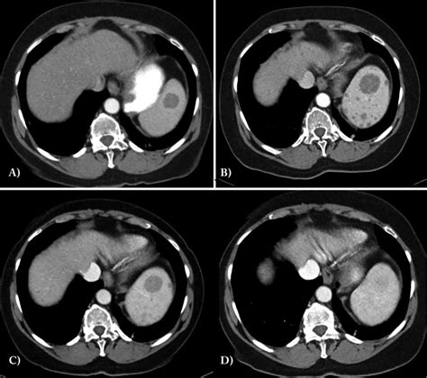 Ct Images In A And B Show Progression Of Splenic Involvement Over 3