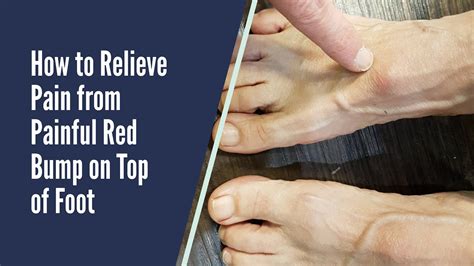 Pain Relief For Red Bump On Top Of Foot Youtube