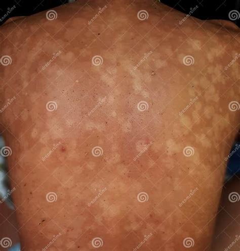 Tinea Versicolor Pityriasis Versicolor Skin Infection On The Back Is A