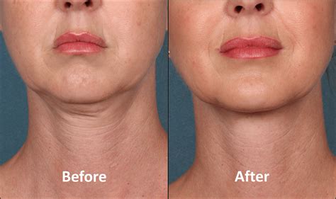 Kybella Patient Before And After Front View Bay Pointe Dermatology