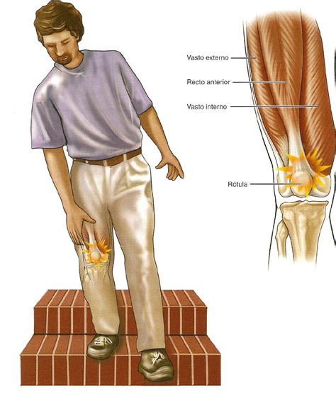 ¿qué Es Un Edema óseo Y Cómo Debes Curarlo