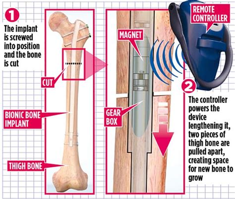 Bionic Bone Procedure That Grows Implant Inside The Leg Could Help