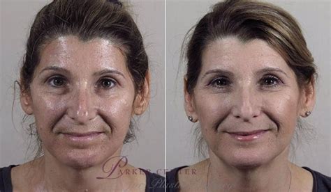 Nonsurgical Face Procedures Before And After Photo Gallery Paramus