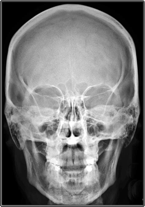 X Ray Nasal Bone Ap View Position Skull X Ray Views Pdf Note The