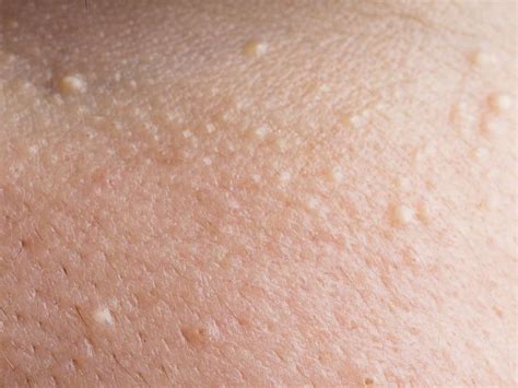 White Spots On The Skin Possible Causes And Treatments