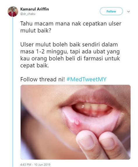 Mata Ikan Di Mulut 🔥apa Itu Ulser Mulut Punca Kesan Dan Kaedah Rawatan Terbaik