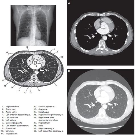 Anatomy Of Chest Ct Scan Automatic Interpretation Of Chest Ct Scans