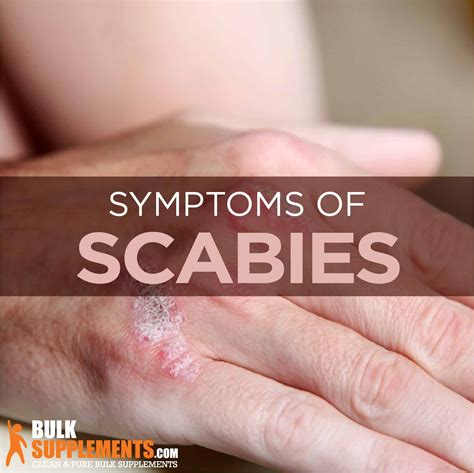 Scabies Rash On Hands Hot Sex Picture Hot Sex Picture