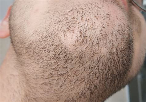 Bald spot after slight injury - will it ever grow back? (I fell down my bike and had a slight ...