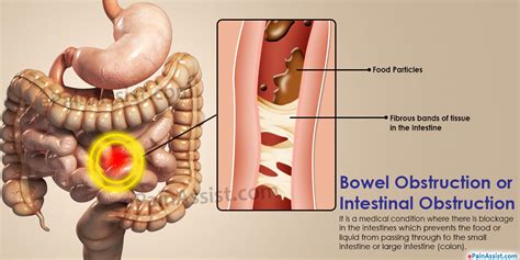 Bowel Obstruction Treatment Causes Symptoms Signs Risk Factors