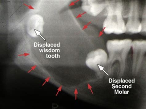 Wisdom Tooth Cyst On Gum
