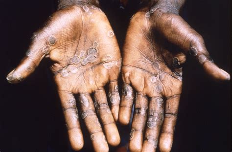 What Does A Monkeypox Rash Look Like Symptom Progression Explained