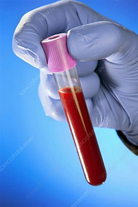 Blood Sample Stock Image C0199983 Science Photo Library