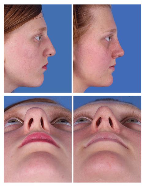 Nasal Reconstruction Rhinoplasty For Severe Nasal Deformity A Photo My XXX Hot Girl