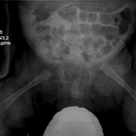Ap Pelvis Radiograph Taken 10 Days Post Operatively In Hip Spica Cast