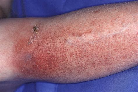 Lower Extremity Cellulitis Diagnosed With Increased Accuracy Using Alt 70 Predictive Model Vs