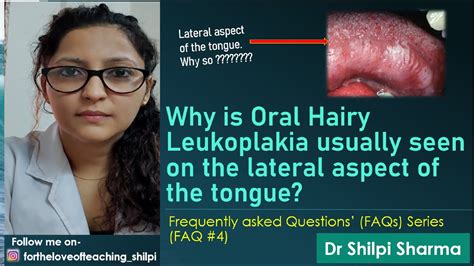 FAQ 4 Why Is Oral Hairy Leukoplakia Usually Seen On The Lateral