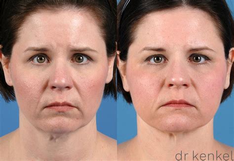 Neck Lift And Lower Facelift In Dallas And Frisco Tx Dr Jeffrey Kenkel