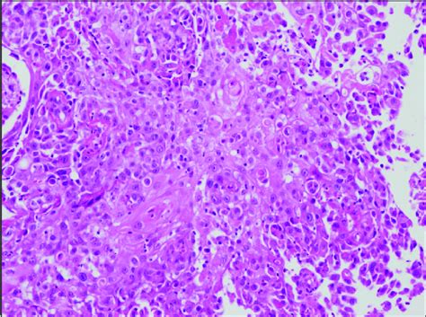 Histopathology Of Biopsied Specimen Showing Squamous Cell Carcinoma Of Download Scientific