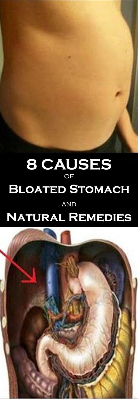 8 Causes Of Bloated Stomach And Natural Remedies Bloated Stomach Bloating Remedies Stomach